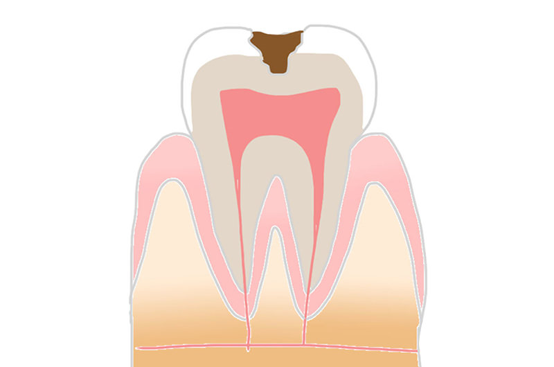 C2象牙質のむし歯