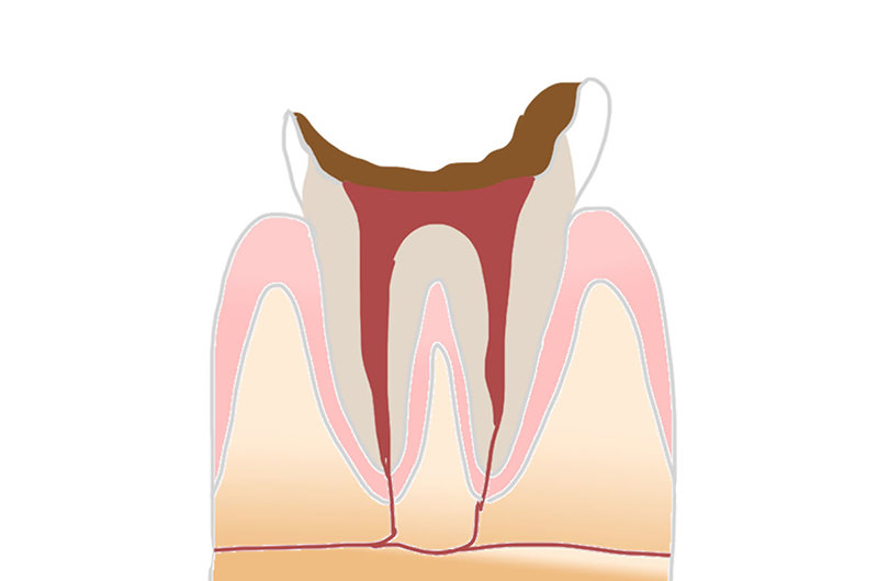 C4末期のむし歯