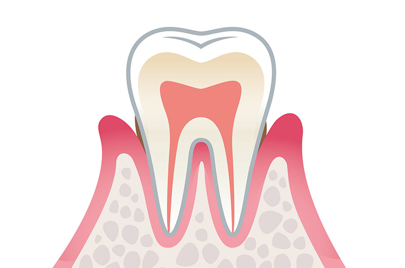 軽度歯周炎